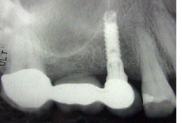 Tooth Implant Bridge