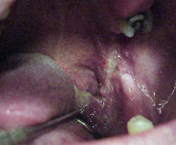 Oral Lesion