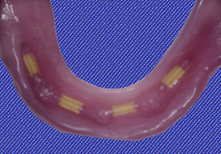 Denture Prosthesis