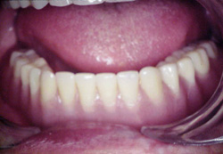Implant Dentures After