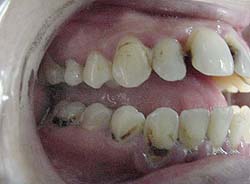 Meth Teeth Right