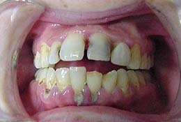 Meth Teeth Front