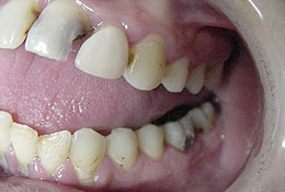 Meth Teeth Left