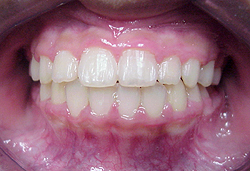 Anterior After