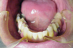 Lower Partial Dentures