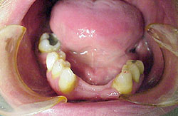 Lower Teeth Before