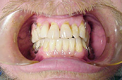 Partial Dentures After