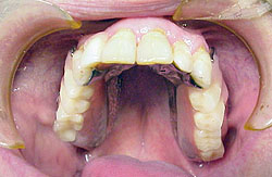 Upper Partial Dentures