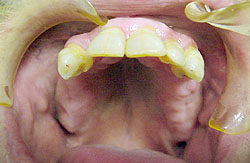 Upper Teeth Before